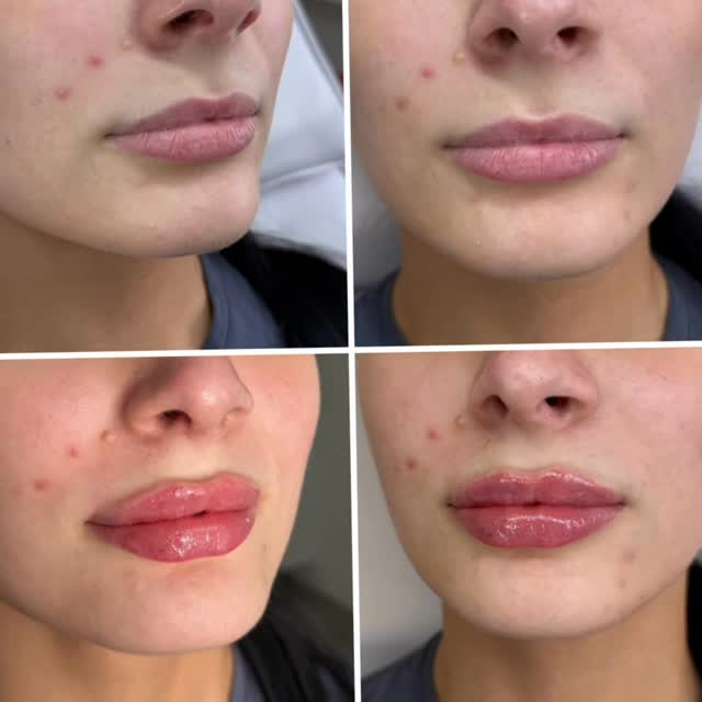 Russian lips — porovnanie pred a po aplikácii